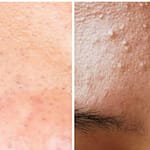 There is no need to go to the parlor to remove the whitehead.