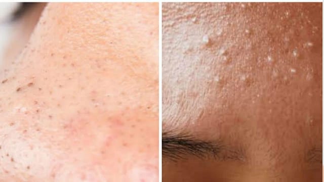 There is no need to go to the parlor to remove the whitehead.